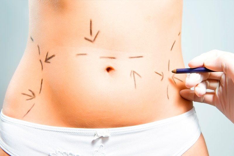 Dermolipectomía Abdominal
