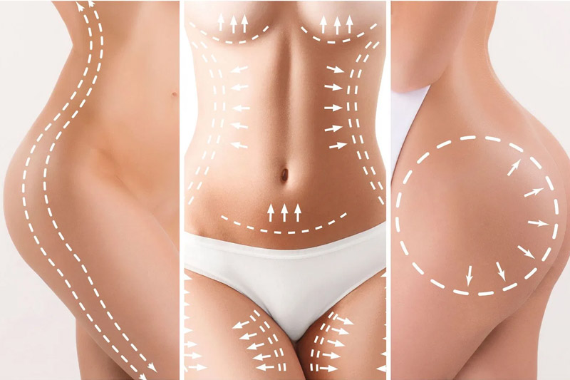 Lipoescultura