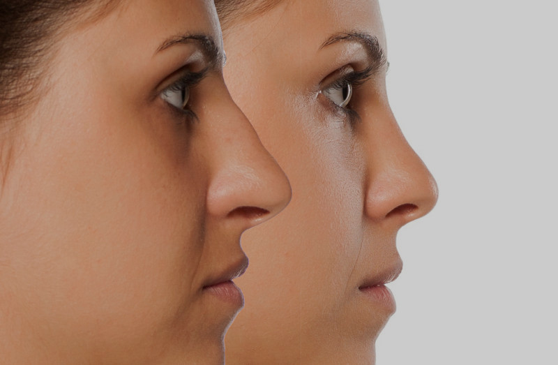 Rinoplastia