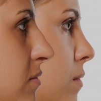 comparative portrait of a young woman before and after nose correction